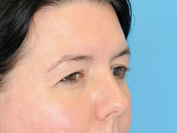 Eye Rejuvenation Before