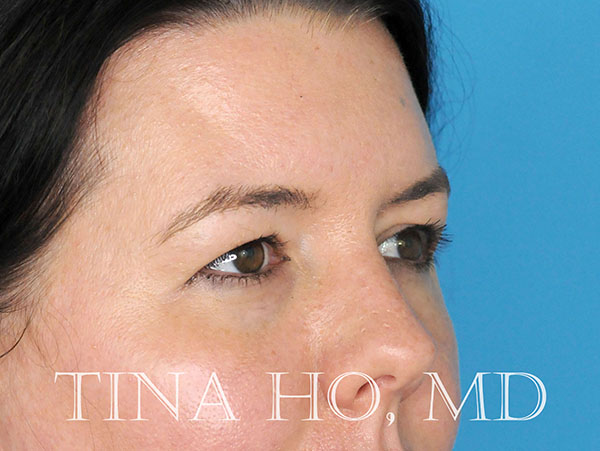 Eye Rejuvenation After