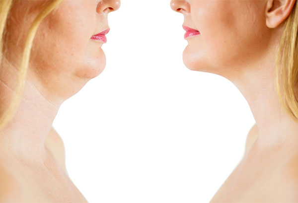 Kybella injection Before & After