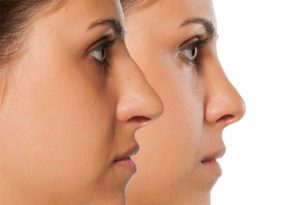 Rhinoplasty Before & After