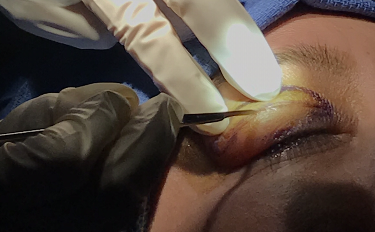 eyelid surgery