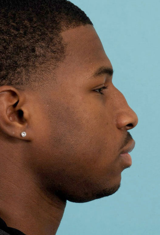 Rhinoplasty Before