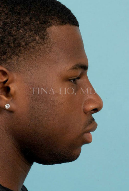 Rhinoplasty After