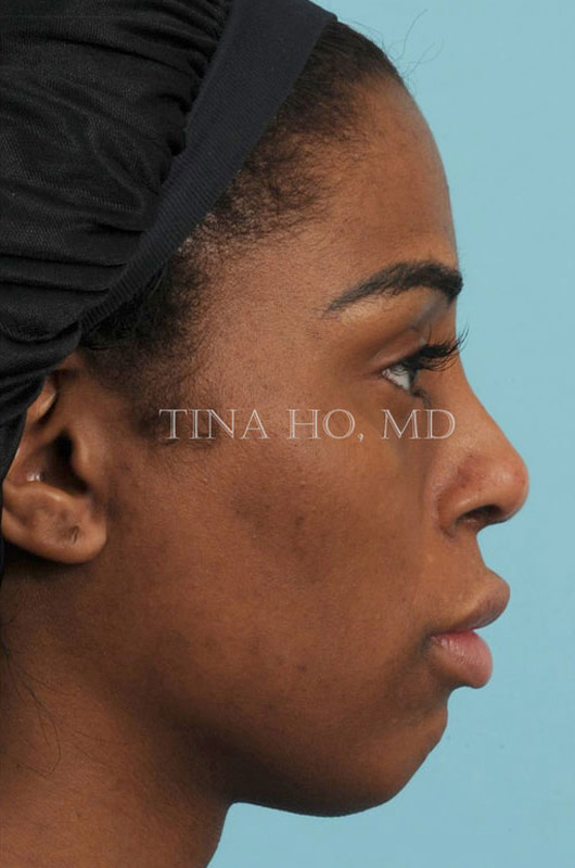 Revision Rhinoplasty After