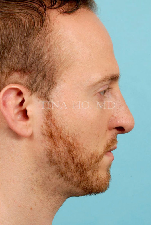 functional rhinoplasty after