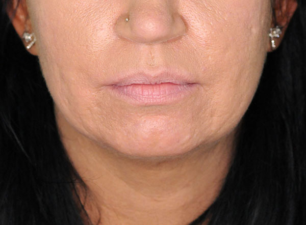 lip augmentation before