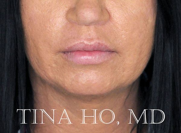 lip augmentation after