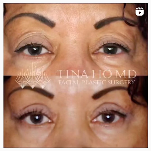 Lower Eyelid Lift Philadelphia Lower Eyelid Lift Surgery Wayne