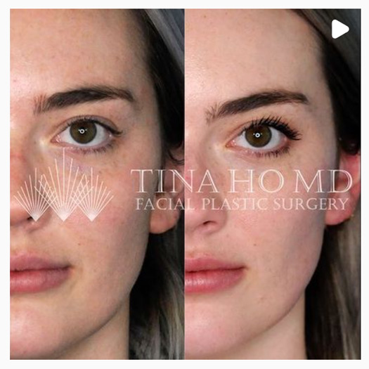 Facial_Contouring_IG_02