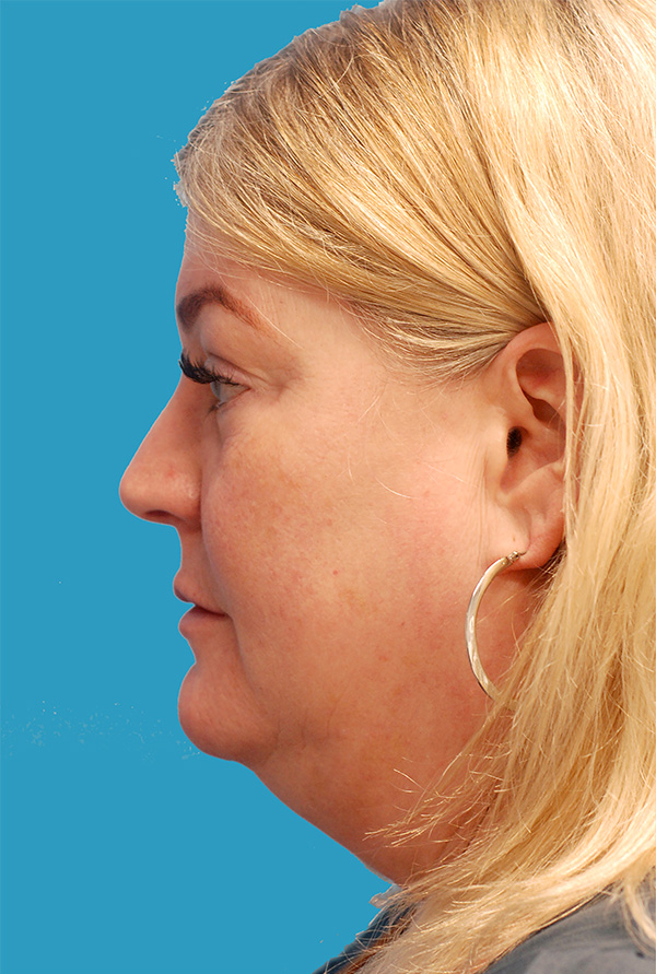 Face Lift Before