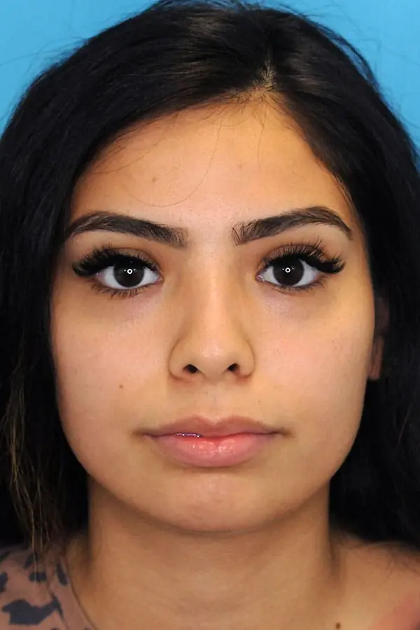 Patient's face showing results before a Philadelphia cheek augmentation procedure