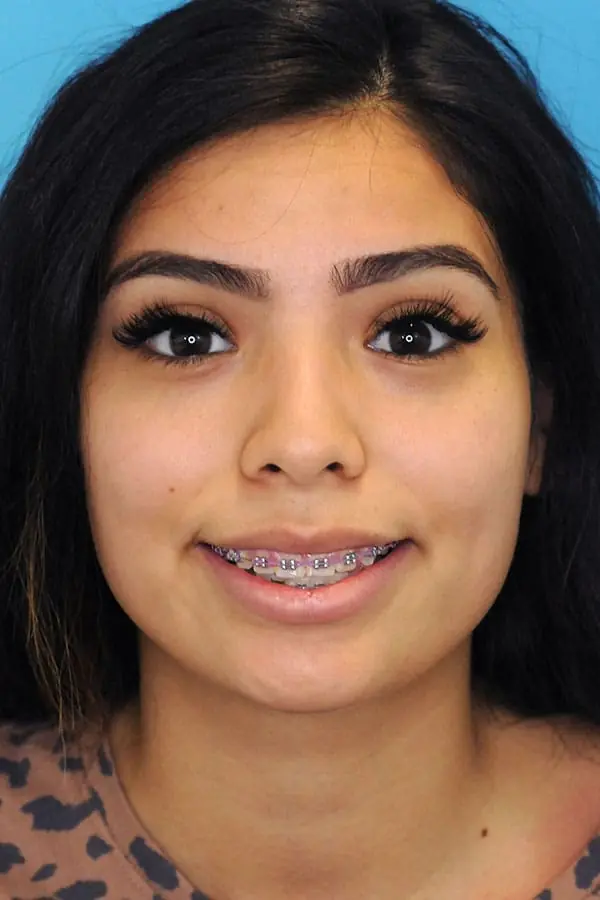 Patient's face showing results before a Philadelphia cheek augmentation procedure