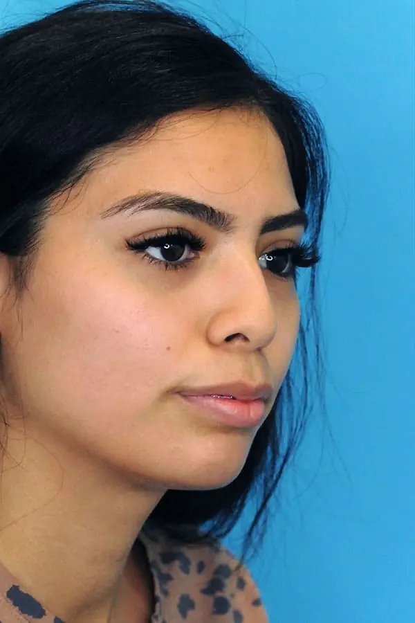 Patient's face showing results before a Philadelphia cheek augmentation procedure