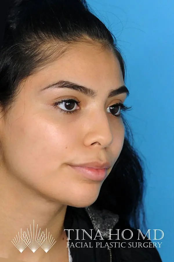 Patient's face showing results after a Philadelphia cheek augmentation procedure