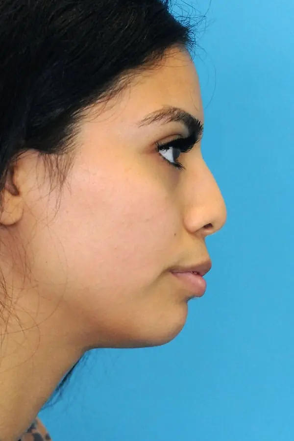 Patient's face showing results before a Philadelphia cheek augmentation procedure