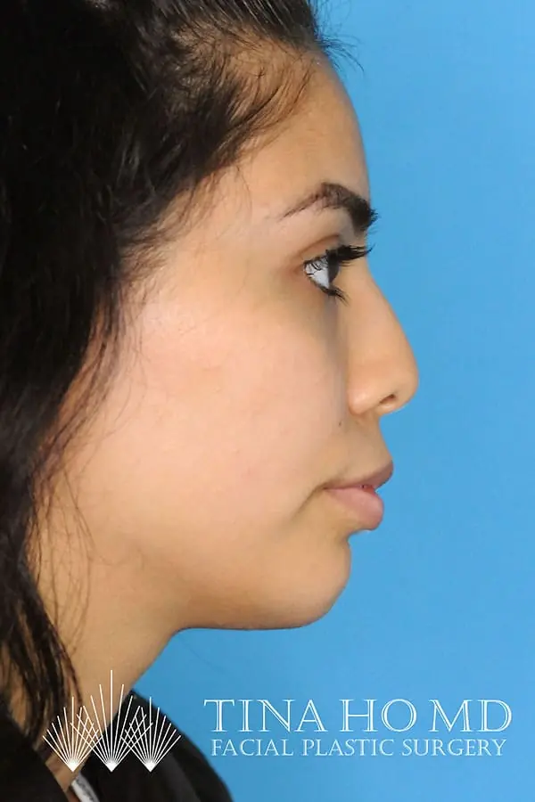 Patient's face showing results after a Philadelphia cheek augmentation procedure