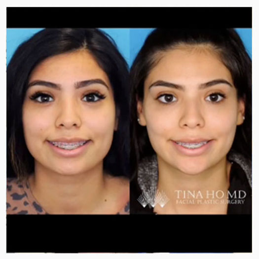Injectables facial contouring
