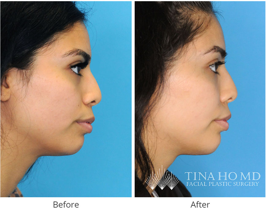 Jawline Contouring - Before and After