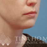 mini neck lift - after - right oblique