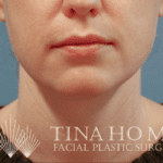 after mini neck lift frontal view - 30 year old patient