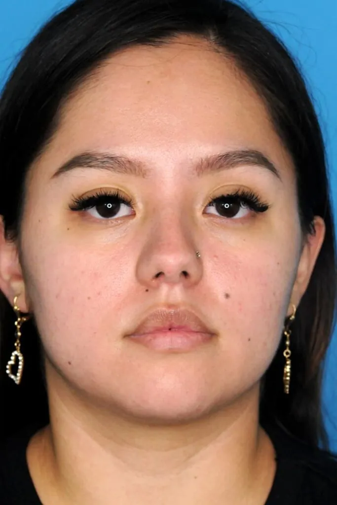 Patient's frontal view before chin augmentation procedure