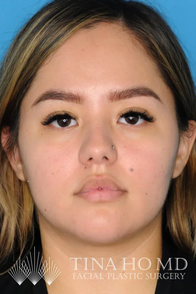 Patient's frontal view after chin augmentation procedure