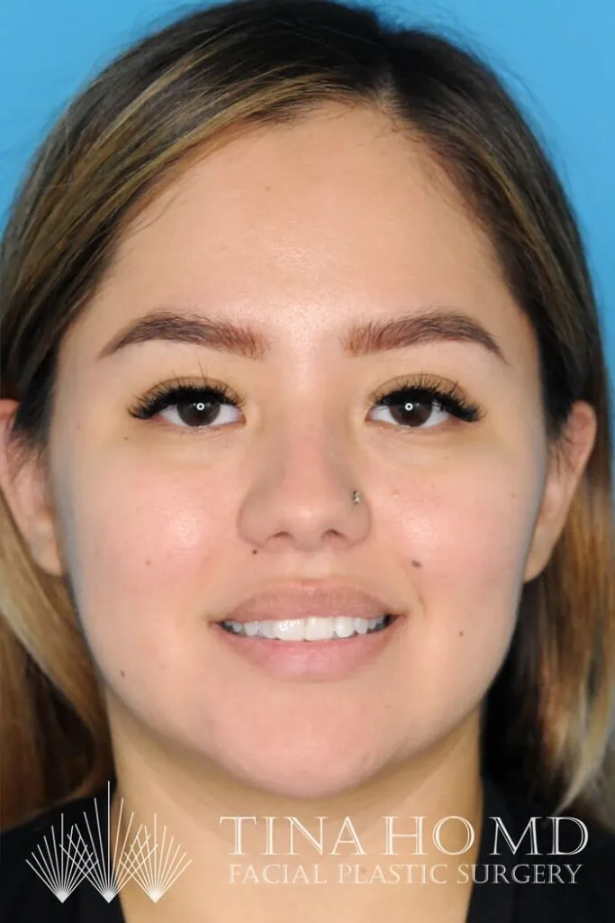 Patient's smiling frontal view after chin augmentation procedure