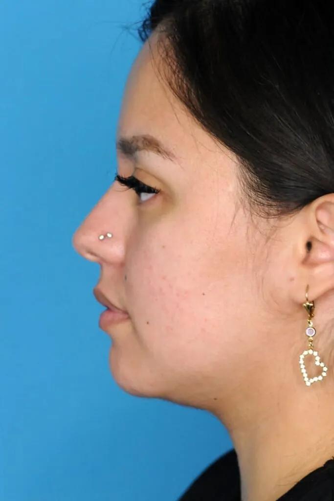 Patient's left side profile before chin augmentation procedure