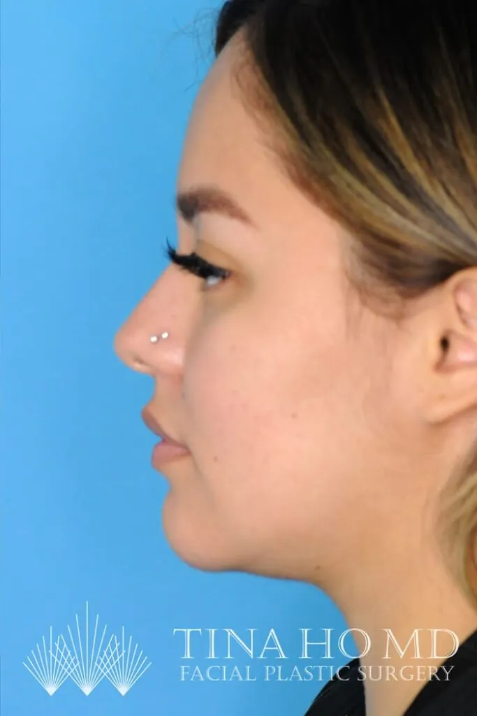 Patient's left side profile after successful chin augmentation procedure