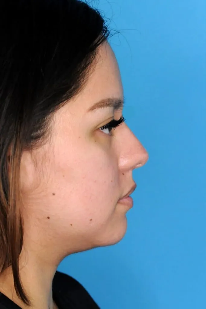 Patient's right side profile before chin augmentation procedure