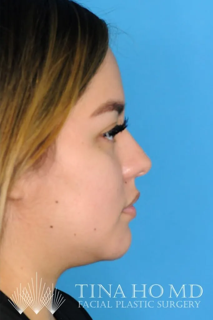 Patient's right side profile after successful chin augmentation procedure