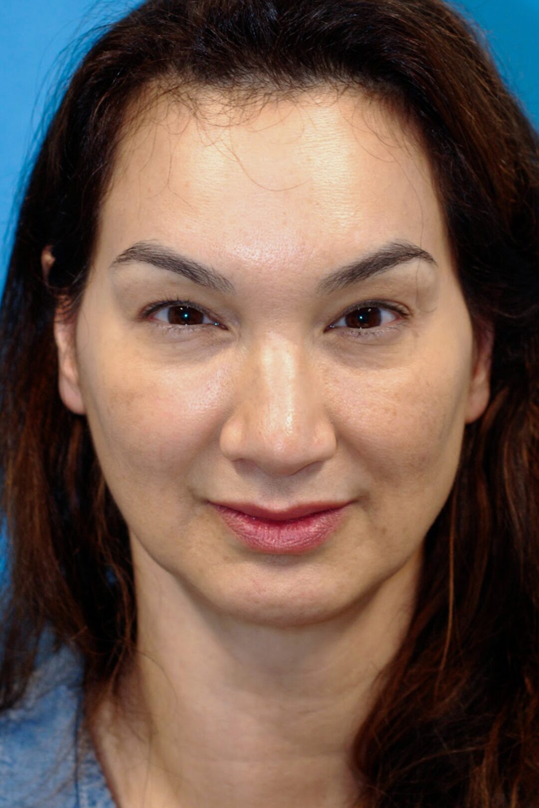 Asian blepharoplasty