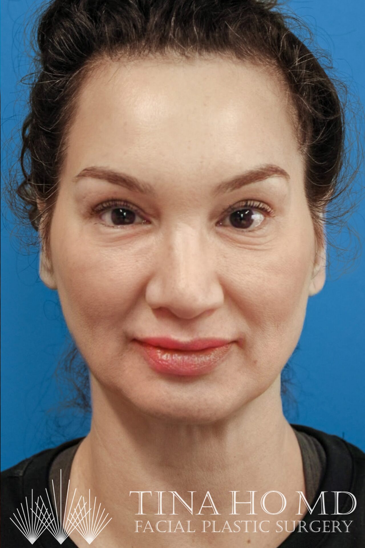 Facial Fat Transfer Philadelphia Facial Fat Grafting Wayne