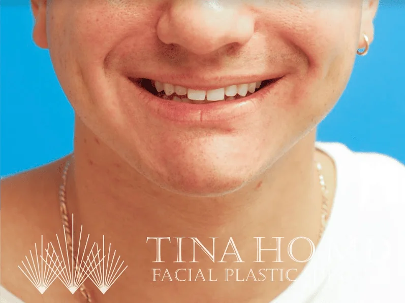 Patient's smiling frontal view after chin augmentation and jawline contouring procedure