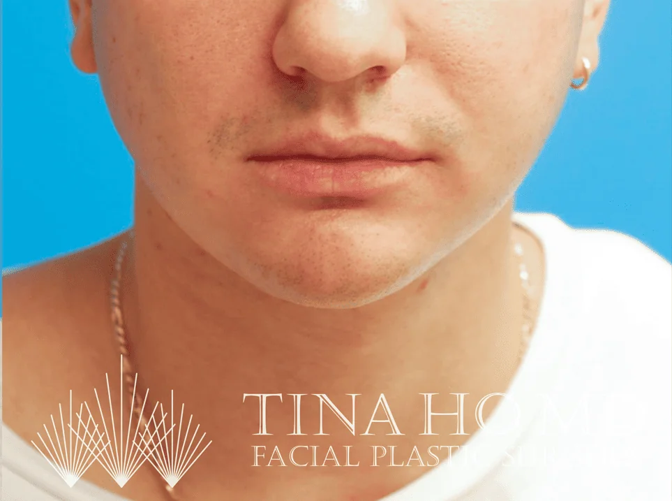 Patient's frontal view after chin augmentation and jawline contouring procedure