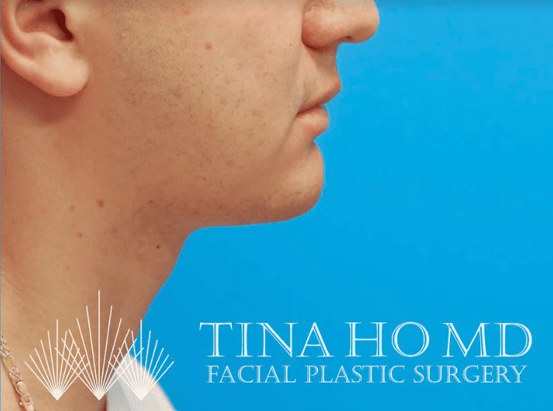 Patient's left lateral view after chin augmentation and jawline contouring procedure