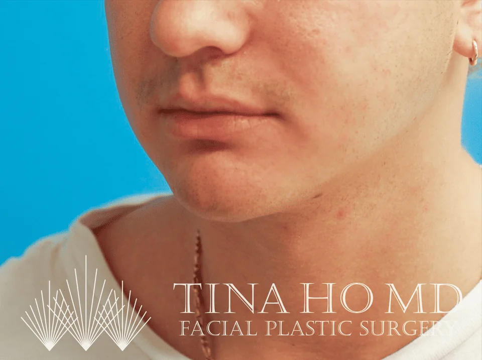 Patient's oblique view after chin augmentation and jawline contouring procedure
