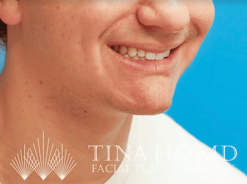 Patient's smiling right oblique view after chin augmentation and jawline contouring procedure