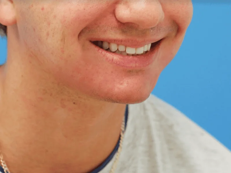 Patient's smiling right oblique view before chin augmentation and jawline contouring procedure