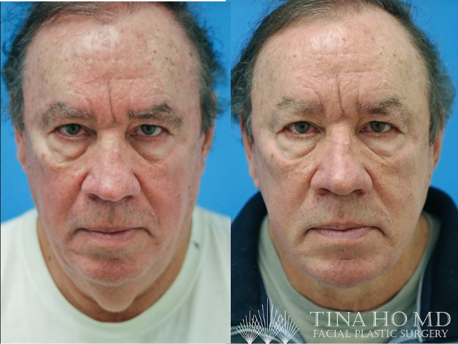 facelift male philadelphia