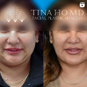 Injectables facial contouring