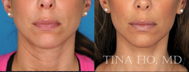 liquid face lift before and after 