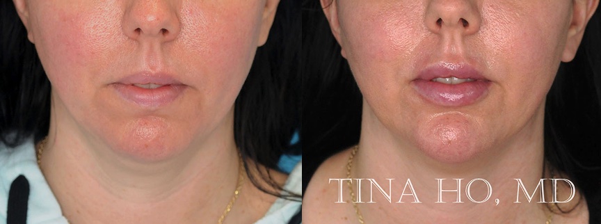 Rhinoplasty & Lip Augmentation