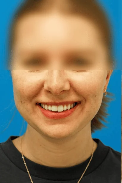 Patient's face before chin, neck and submental liposuction