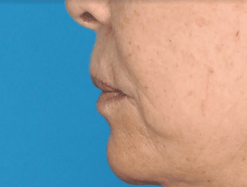 Before lip filler showing a person's natural lips