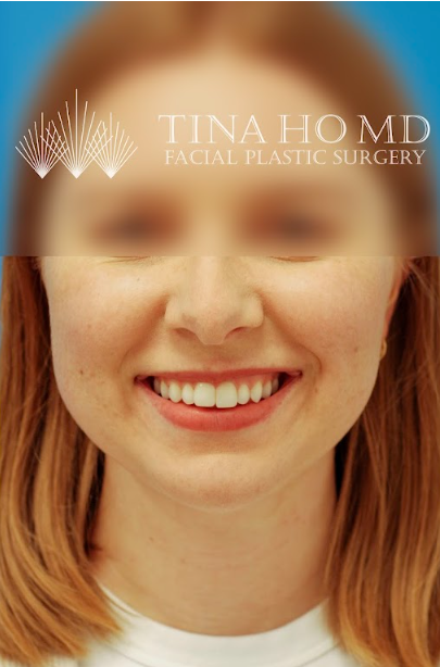 Patient's face after chin, neck and submental liposuction