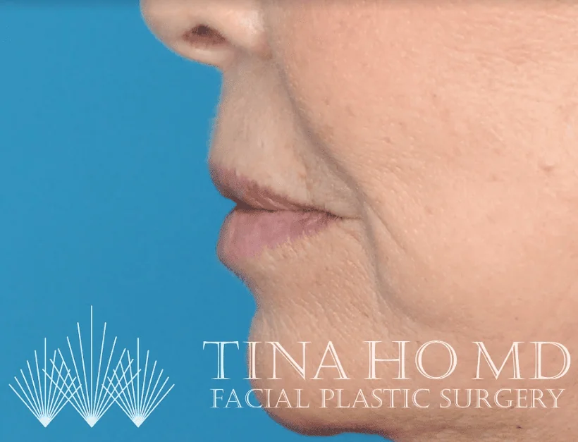 After lip filler showing fuller, more defined lips