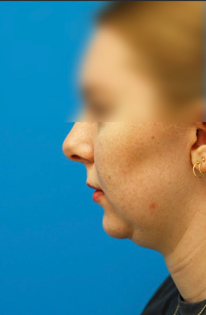 Patient's face before chin, neck and submental liposuction