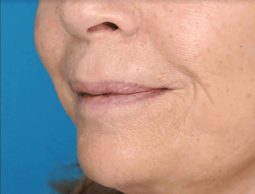 Before lip filler showing a person's natural lips