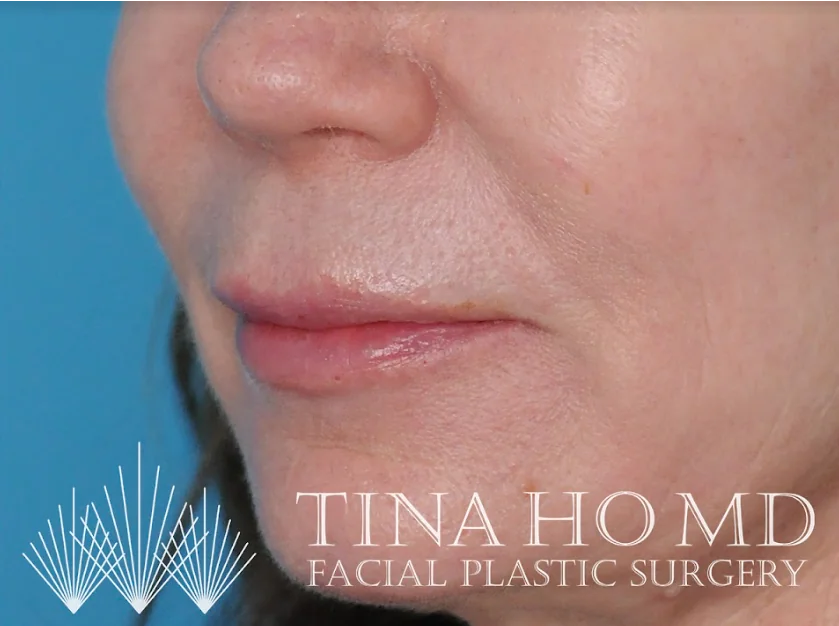 After lip filler showing fuller, more defined lips